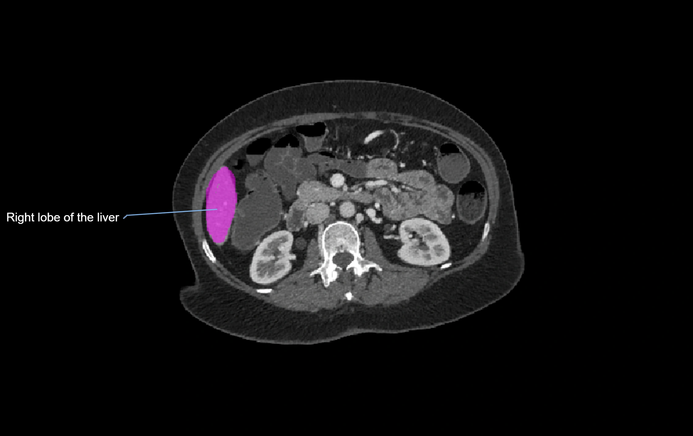 CT lliver lobes axial cross sectional anatomy labelled image -00014.webp
